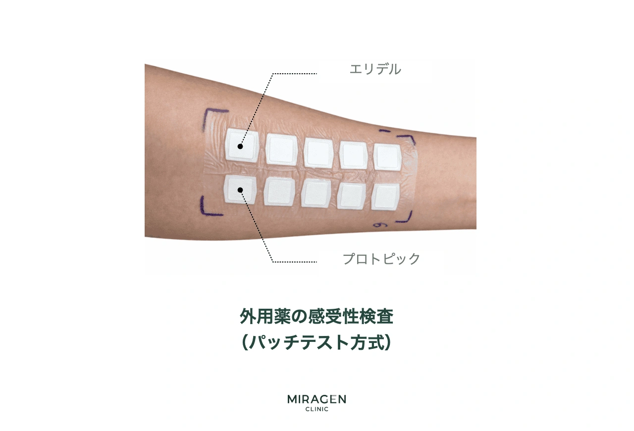 腕の内側にエリデル・プロトピックなどの外用剤を貼り、皮膚反応を見るパッチテストの写真
