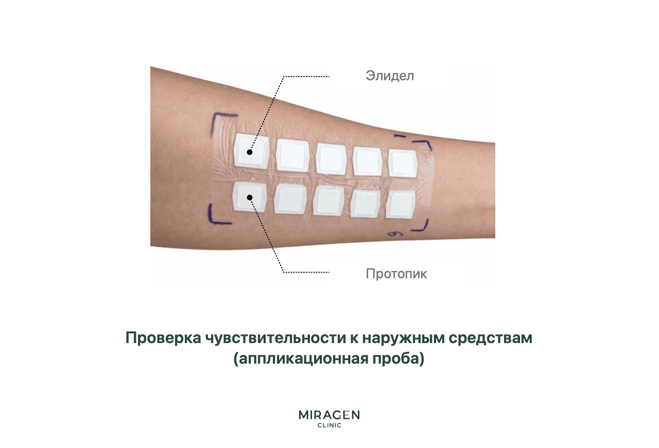 Фотография аппликационной пробы на внутренней стороне руки для оценки реакции кожи на местные средства, включая Протопик и Элидел