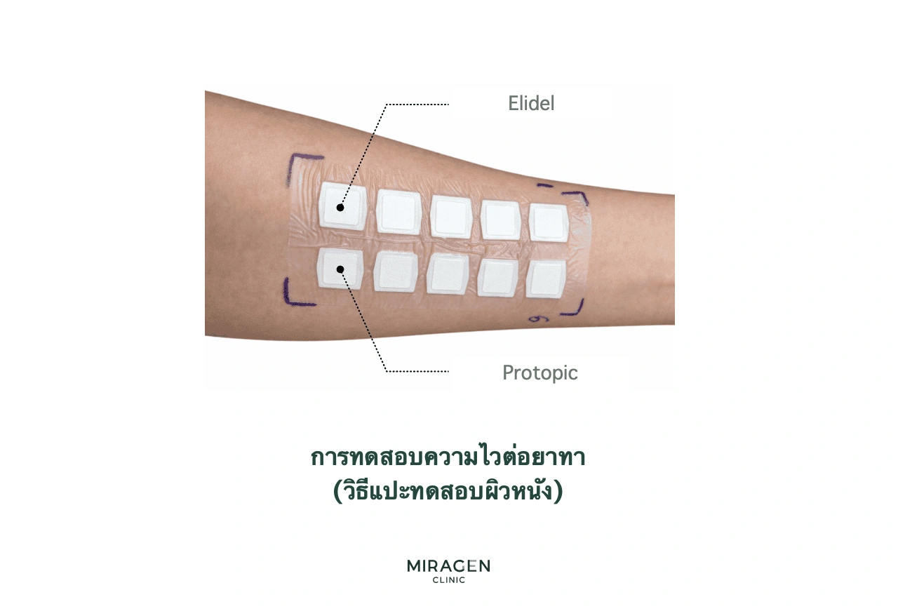 ภาพการทดสอบแปะผิวโดยติดเอลิเดล โปรโตปิก และยาทาอื่นด้านในแขนแล้วดูปฏิกิริยาผิว