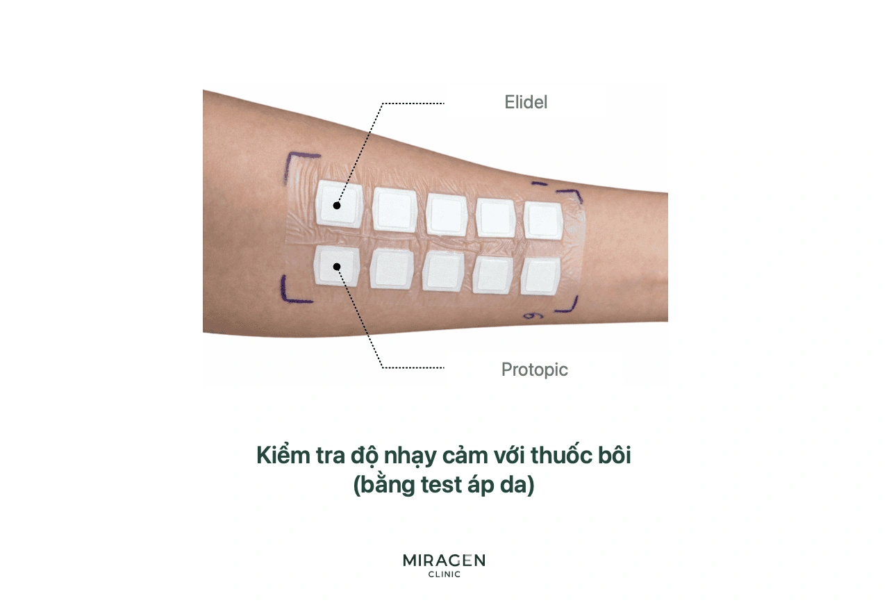 Ảnh thử nghiệm áp da bằng cách đặt Protopic, Elidel và các thuốc bôi khác ở mặt trong cánh tay để quan sát phản ứng da