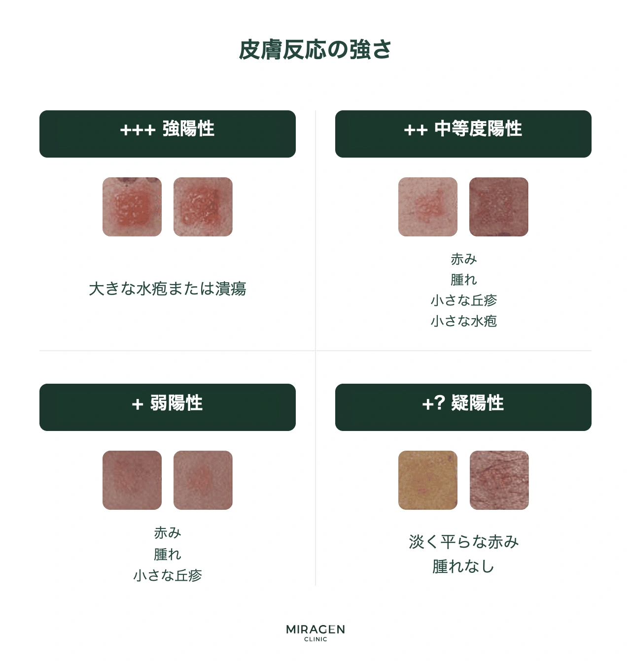 パッチテスト結果判定基準表 — 反応強度による陰性(−)・疑陽性(±)・陽性(+〜+++)の等級分類インフォグラフィック