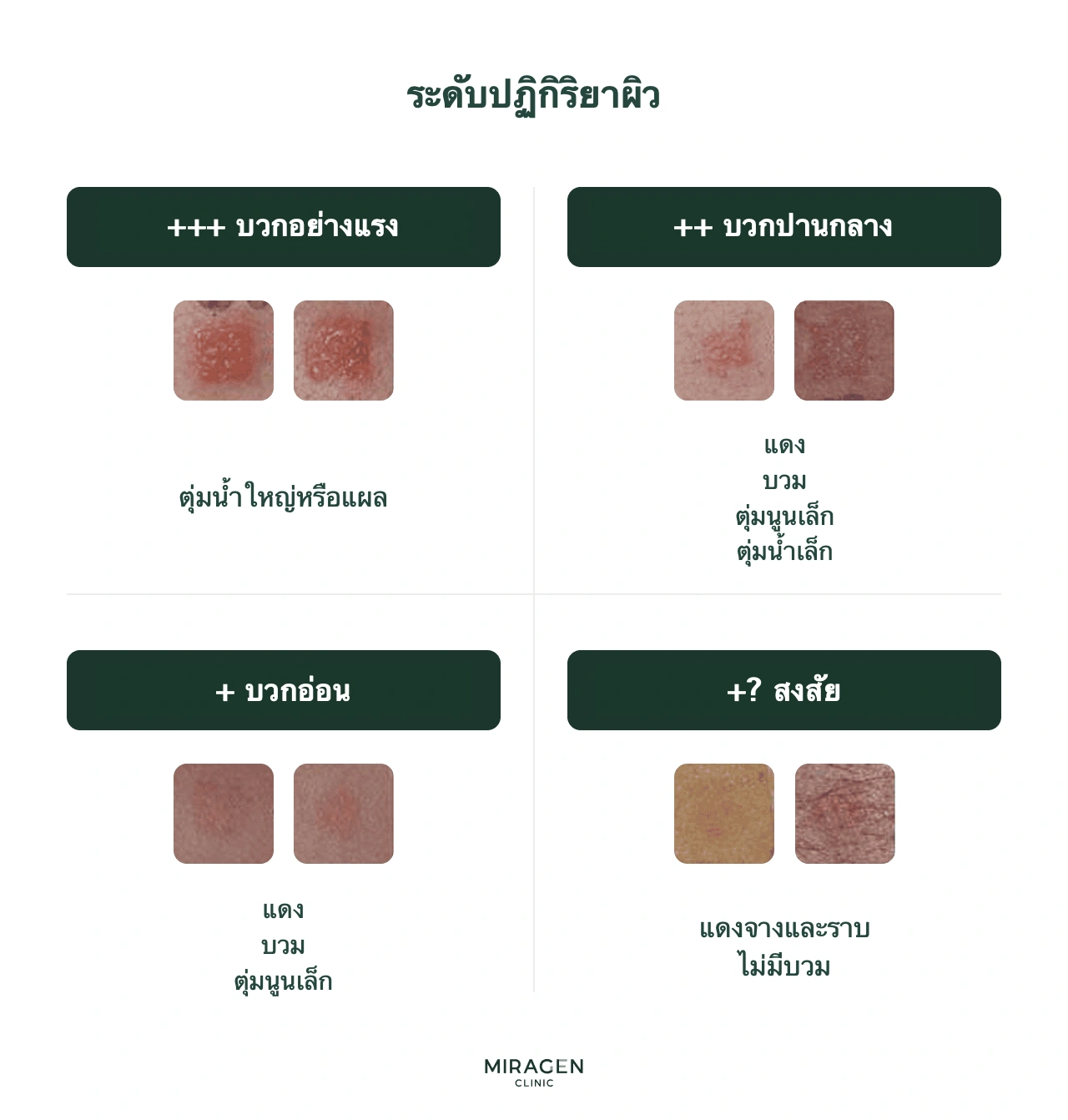 ตารางเกณฑ์อ่านผลการทดสอบแปะผิว จัดระดับตามความแรงเป็นลบ (−) ก้ำกึ่ง (±) และบวก (+ ถึง +++)
