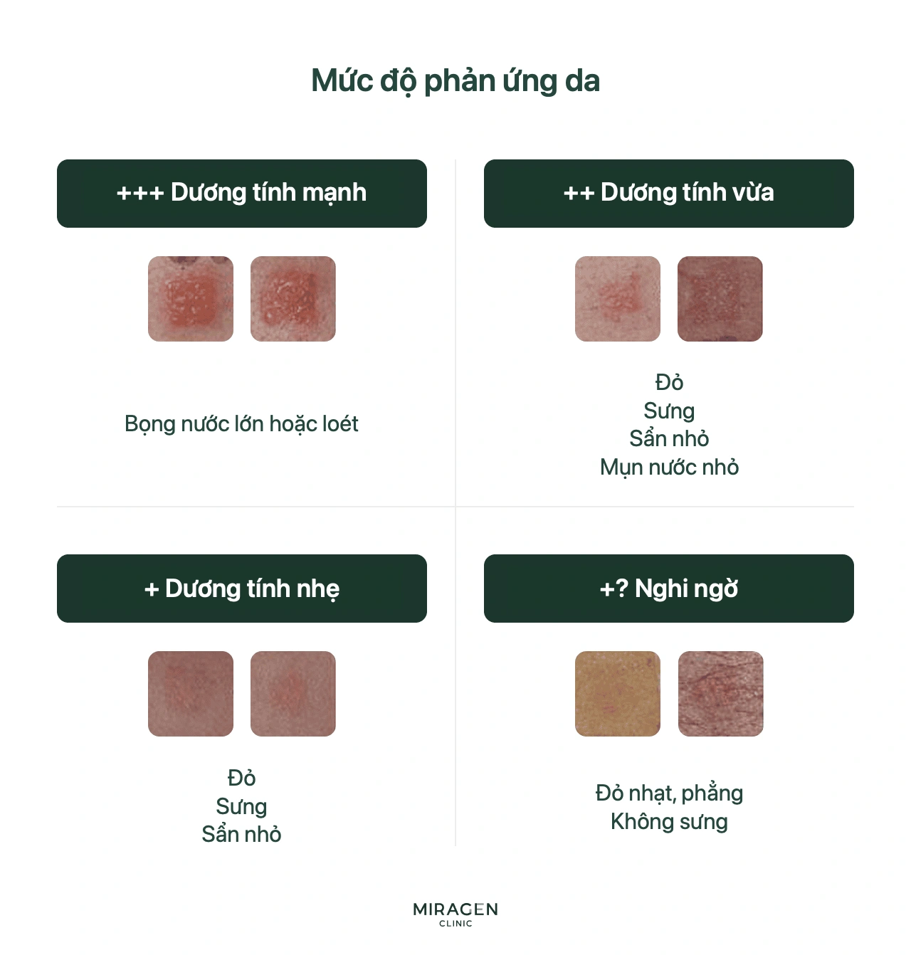 Bảng hướng dẫn đọc thử nghiệm áp trên da, phân loại mức phản ứng âm tính (−), nghi ngờ (±) và dương tính (+ đến +++)