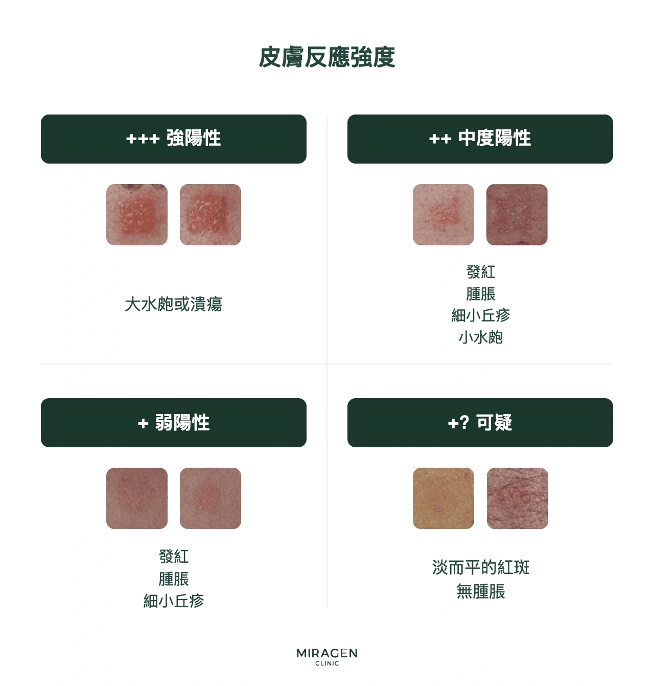 貼膚測試結果判讀標準資訊圖：按反應強度劃分陰性（−）、可疑陽性（±）和陽性（+ 至 +++）