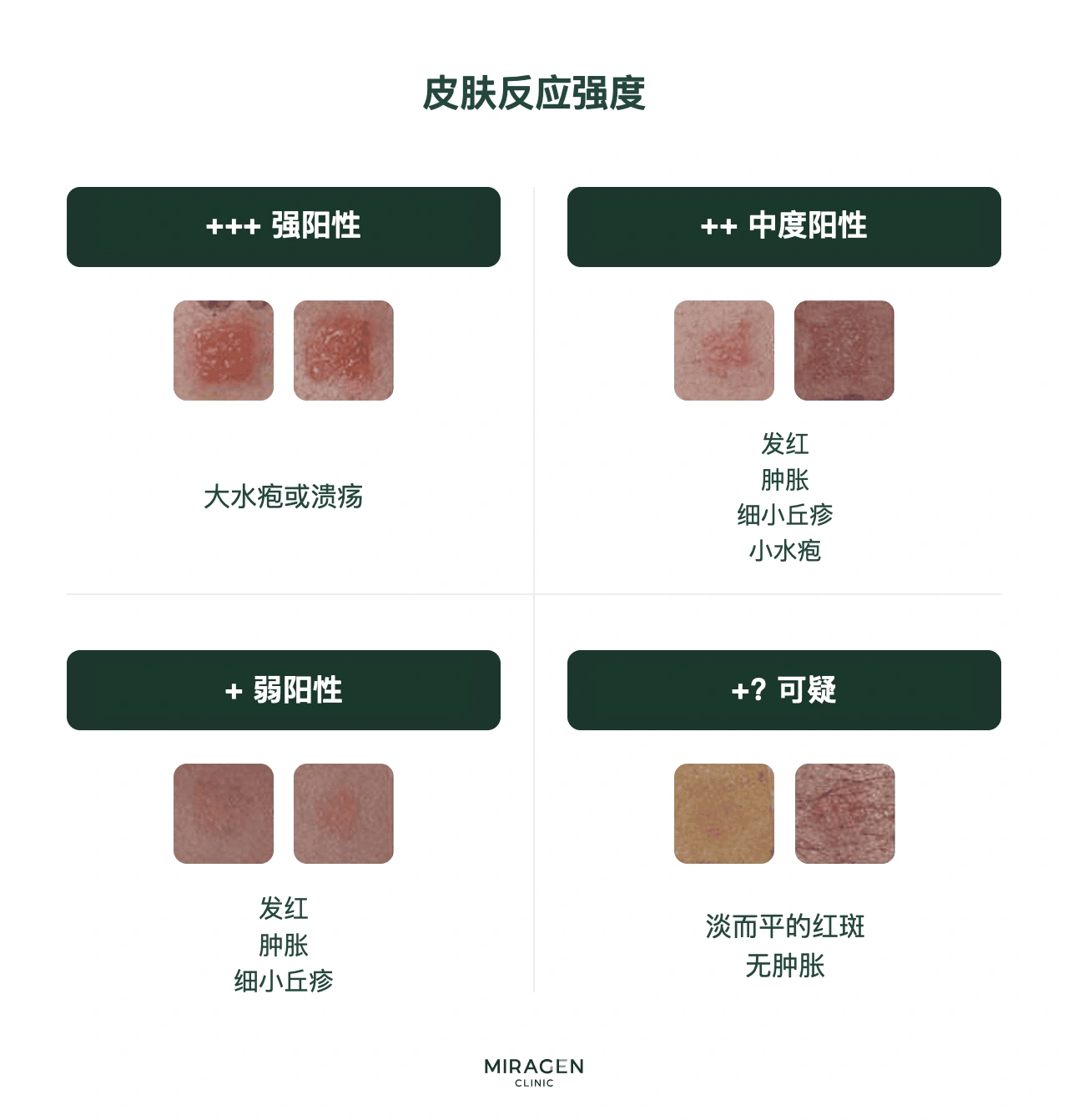 斑贴试验结果判读标准信息图：按反应强度划分阴性（−）、可疑阳性（±）和阳性（+ 至 +++）