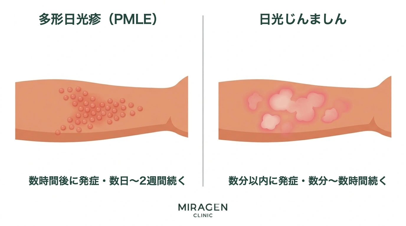 日光アレルギーの代表的な2つの疾患、多形日光疹と日光蕁麻疹の腕の発疹の形状と発生時間を並べて比較した医学イラスト。
