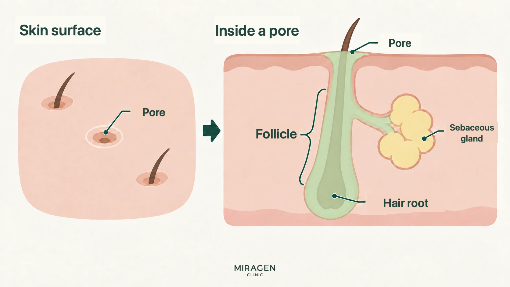 Cross-sectional diagram showing a pore on the skin surface (left), the hair follicle leading below the pore, the connected sebaceous gland, and the hair root at the bottom (right).