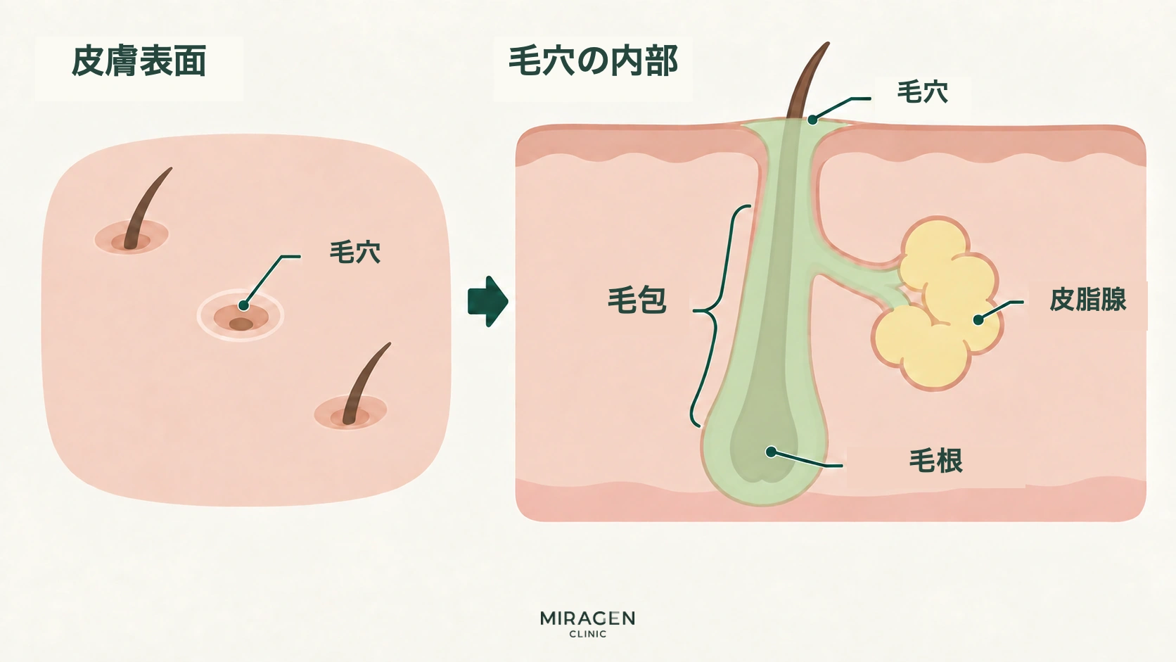 左は皮膚表面の毛穴、右は毛穴の下へ続く毛包と、横につながる皮脂腺および下方の毛根を示した断面図