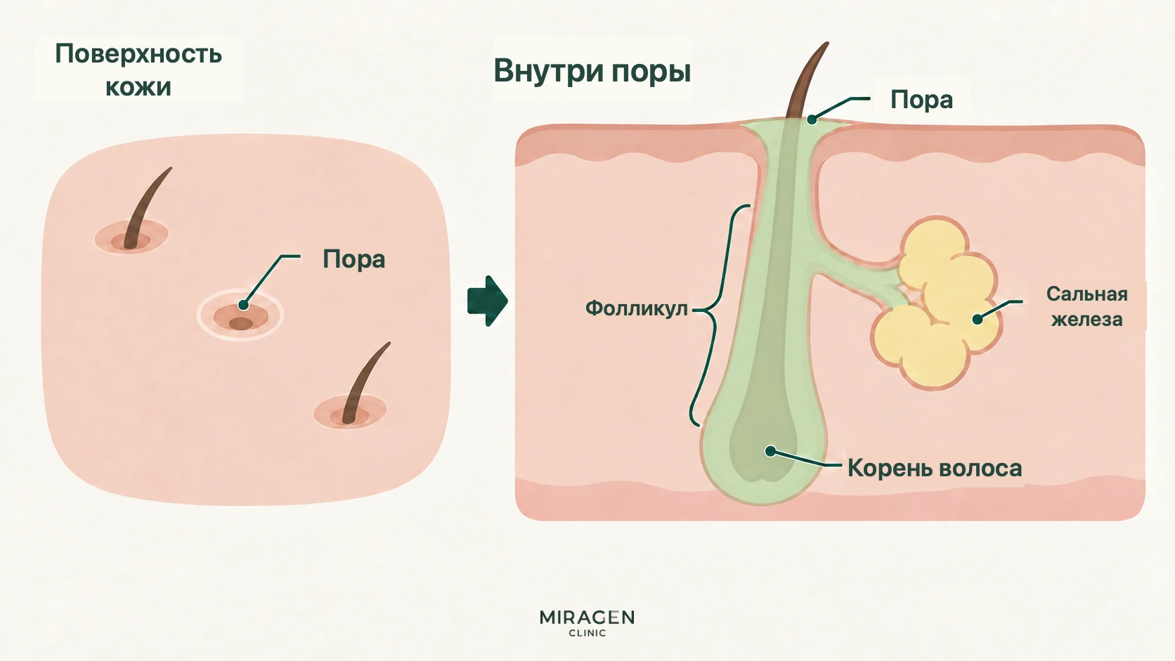 Поперечный разрез кожи показывает пору на поверхности, расположенный под ней волосяной фолликул, соединённую с ним сальную железу и корень волоса