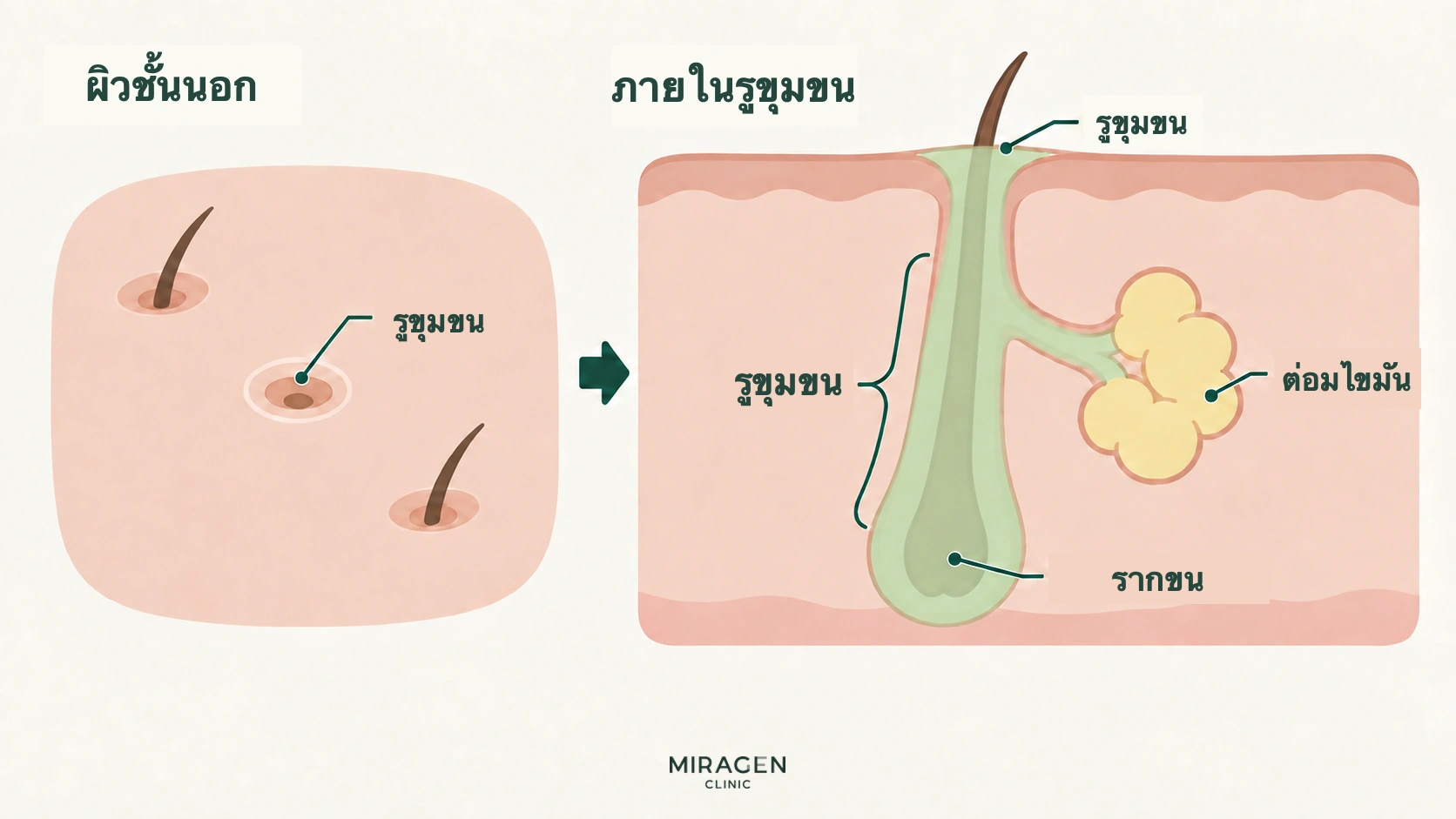 ภาพตัดขวางแสดงรูขุมขนบนผิว ท่อรูขุมขนด้านล่าง ต่อมไขมันที่เชื่อมด้านข้าง และรากขน