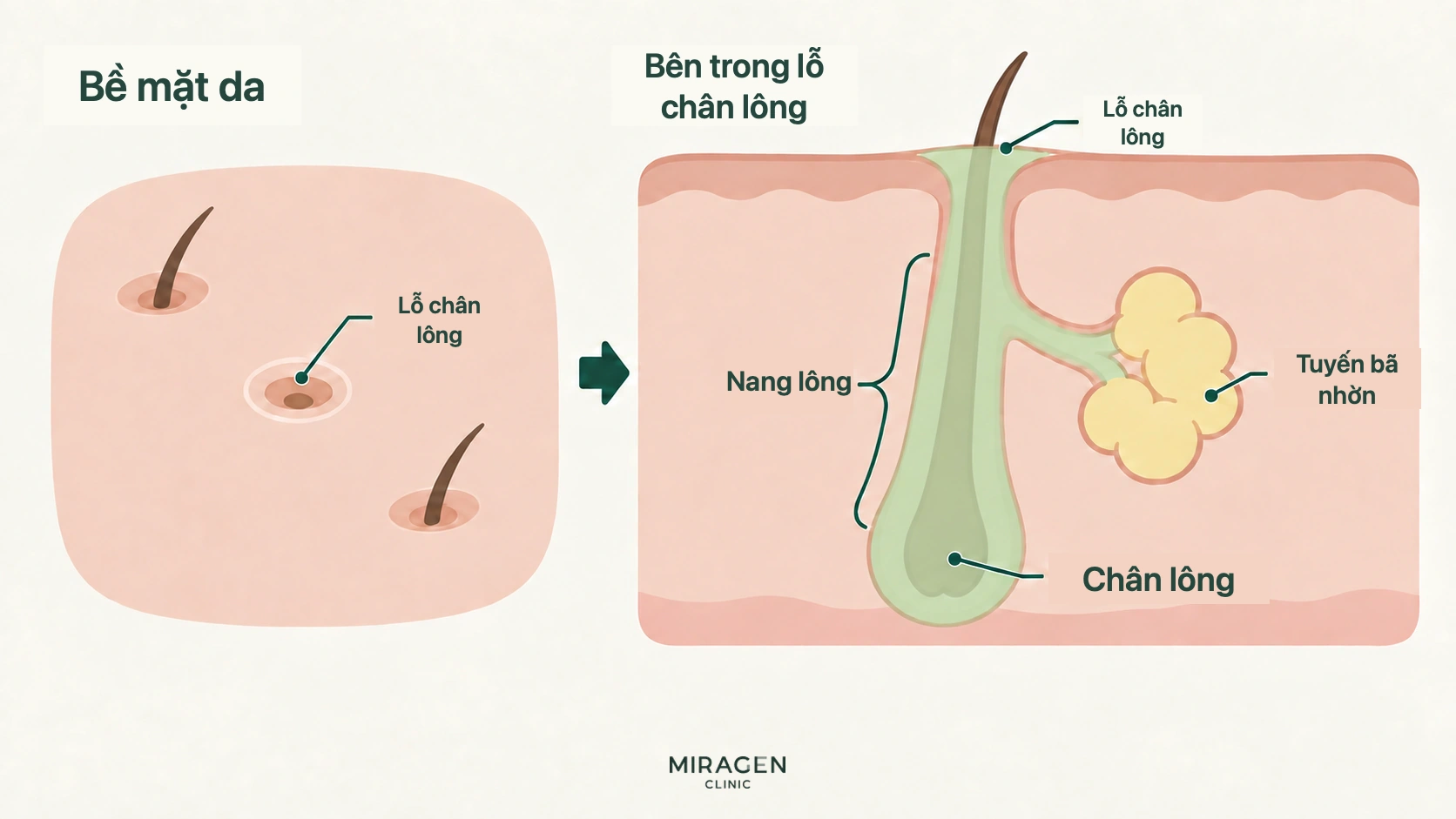 Sơ đồ mặt cắt da cho thấy lỗ chân lông trên bề mặt, nang lông bên dưới, tuyến bã nối bên cạnh và gốc sợi lông