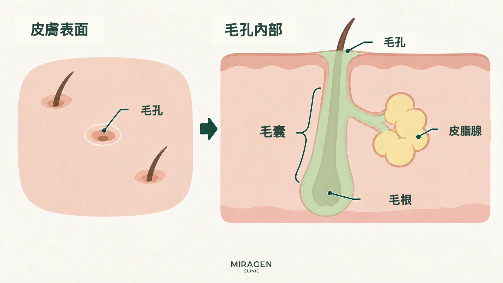 皮膚剖面圖,展示皮膚表面的毛孔、下方的毛囊、側面相連的皮脂腺和毛根
