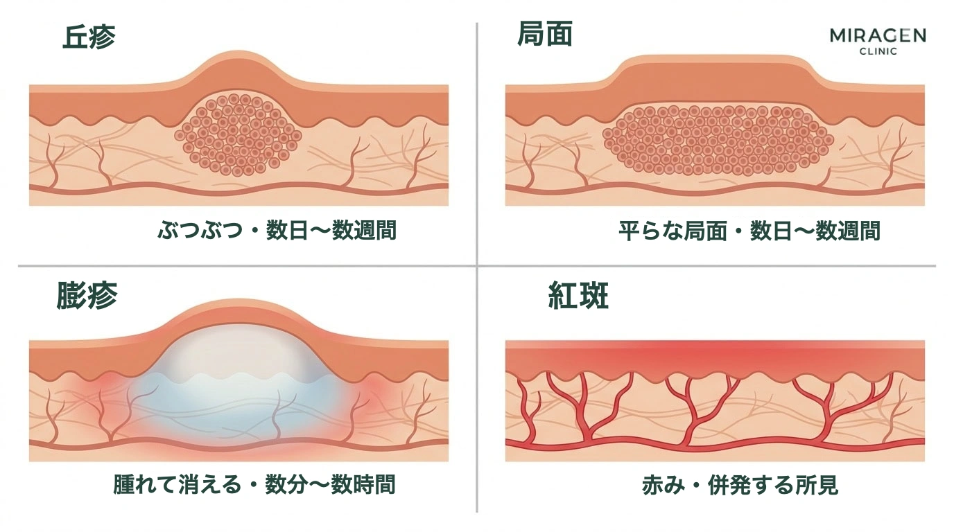発疹用語である丘疹・局面・膨疹・紅斑の皮膚断面形状と持続時間を比較したイラストで、日光アレルギー患者の病変タイプを区別するのに役立ちます。