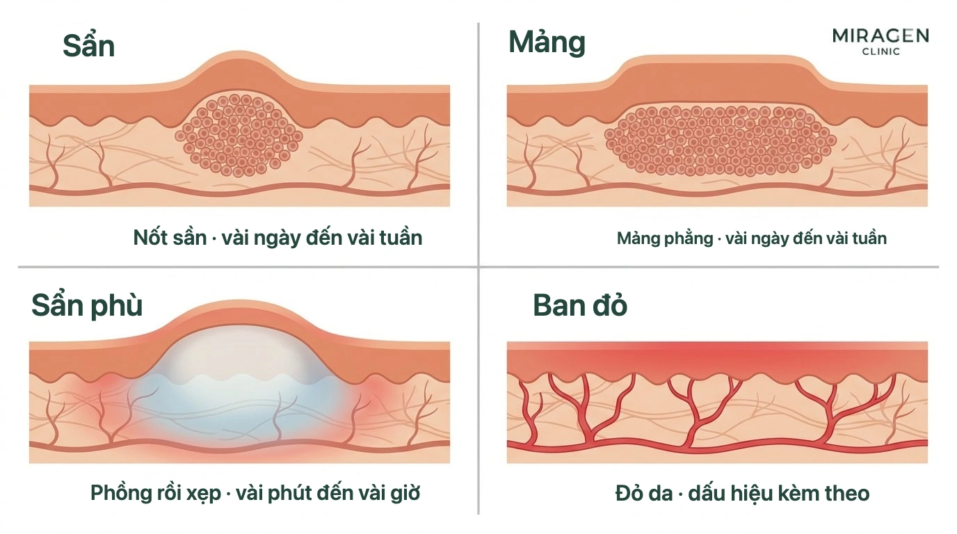 Minh họa so sánh hình dạng trên mặt cắt da và thời gian tồn tại của sẩn, mảng, sẩn phù và hồng ban để phân biệt các tổn thương trong dị ứng ánh nắng