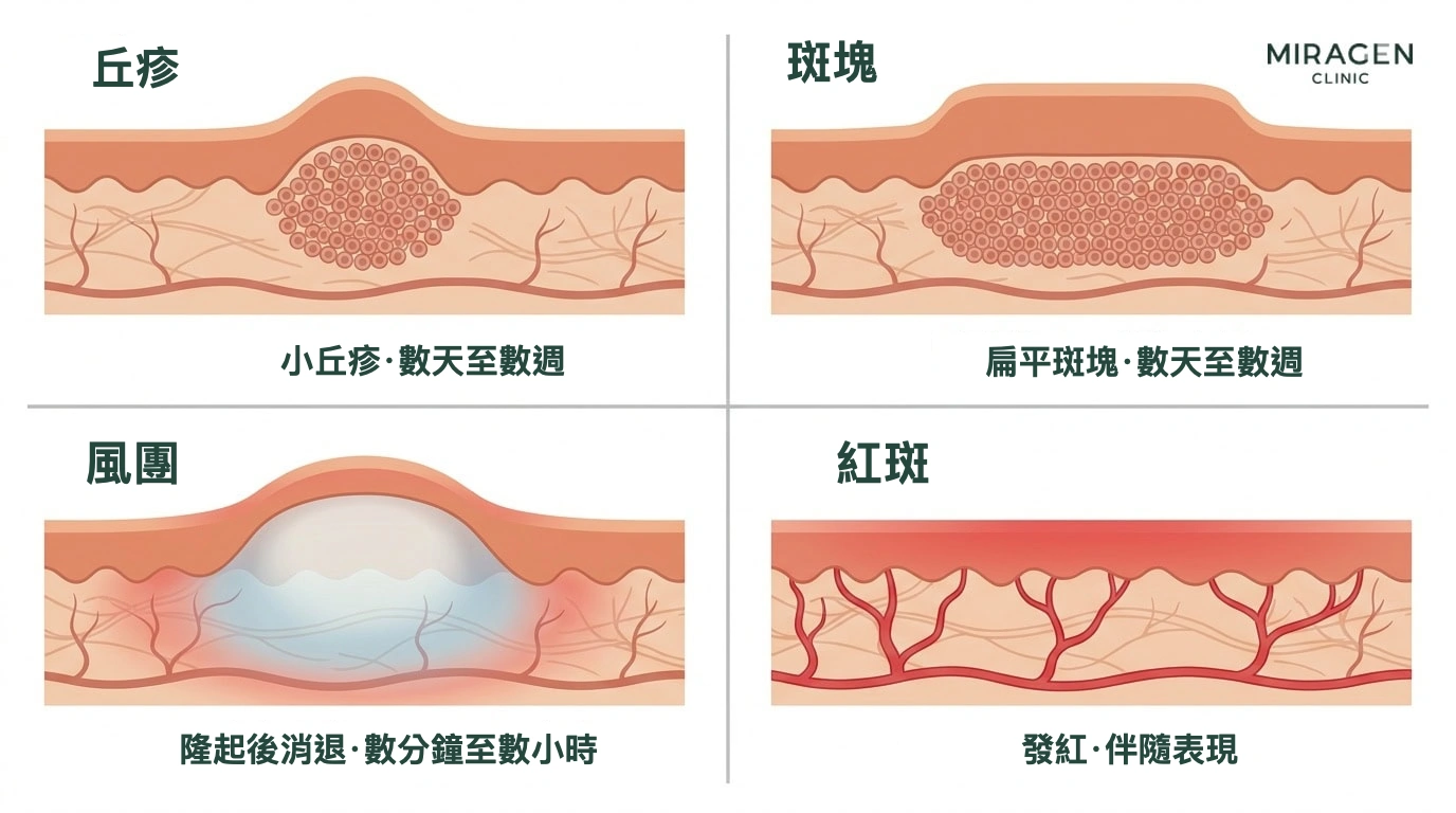插圖比較丘疹、斑塊、風團和紅斑在皮膚剖面中的形態與持續時間，幫助區分日光過敏患者的皮損類型