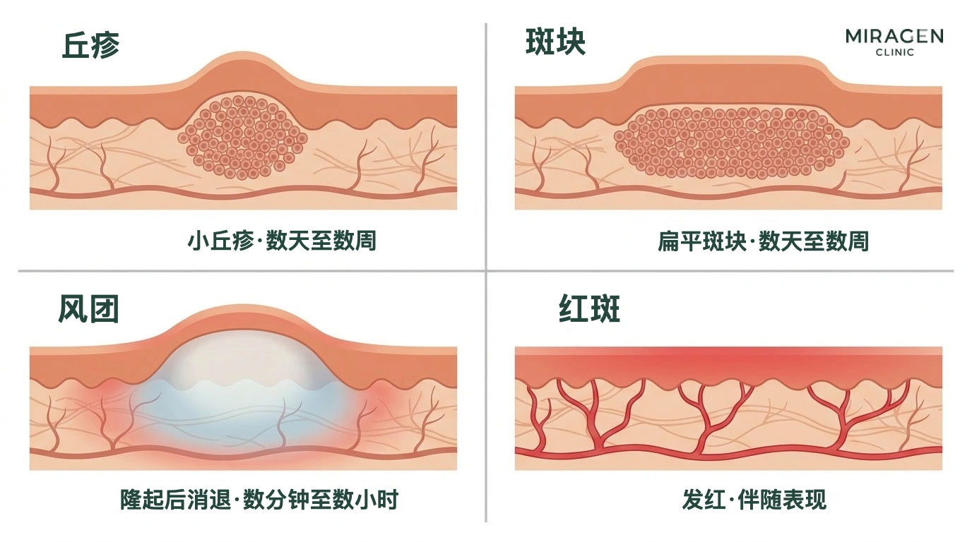 插图比较丘疹、斑块、风团和红斑在皮肤剖面中的形态与持续时间，帮助区分日光过敏患者的皮损类型