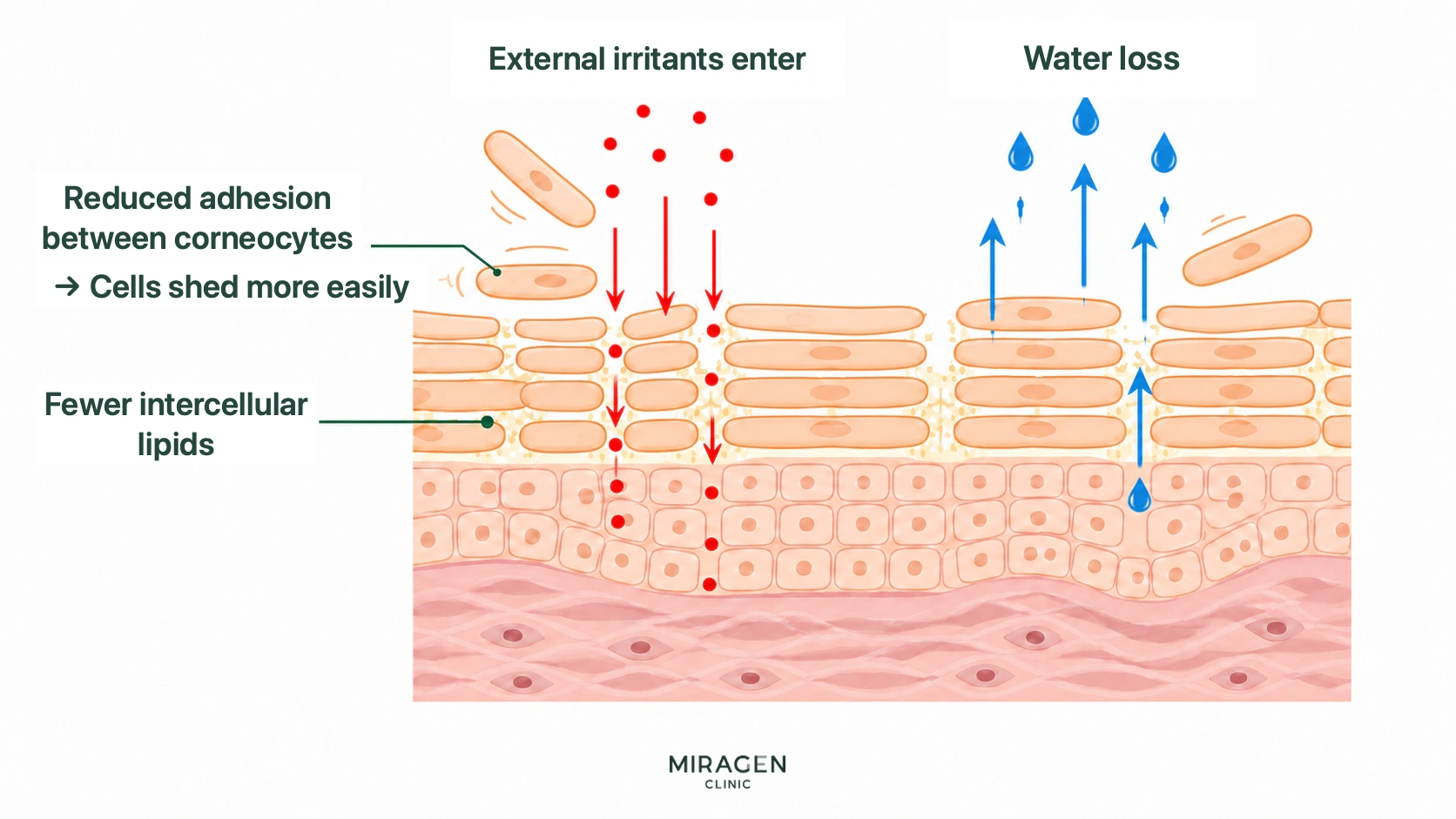An illustration showing skin barrier changes during topical retinoid use, where reduced adhesion between keratinocytes and decreased intercellular lipids make it easier for external irritants to penetrate and moisture to be lost.
