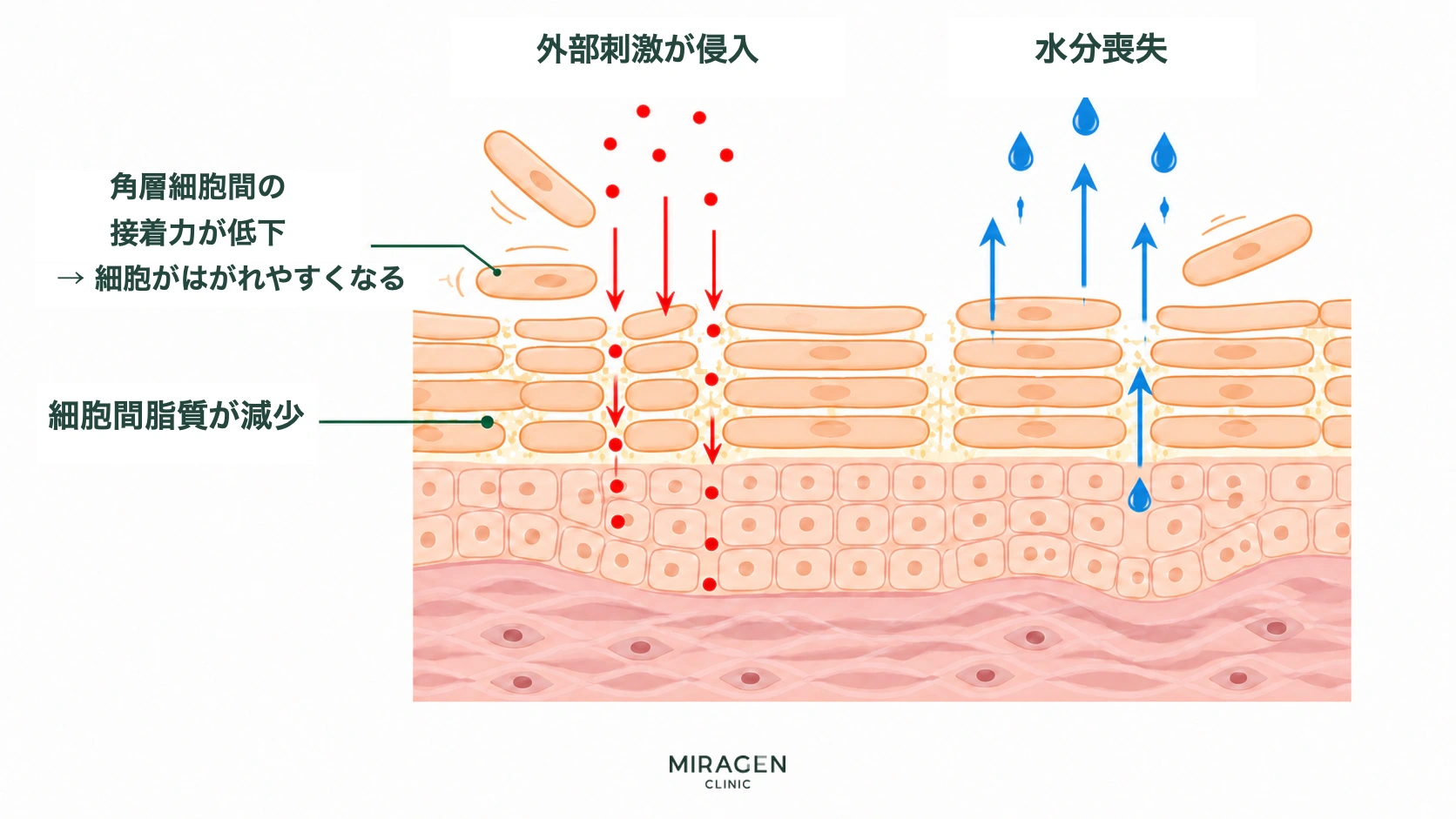 外用レチノイド使用中に、角質細胞間の接着力と細胞間脂質が減少し、外部刺激の侵入や水分損失が起こりやすくなる皮膚バリアの変化を示す図です。