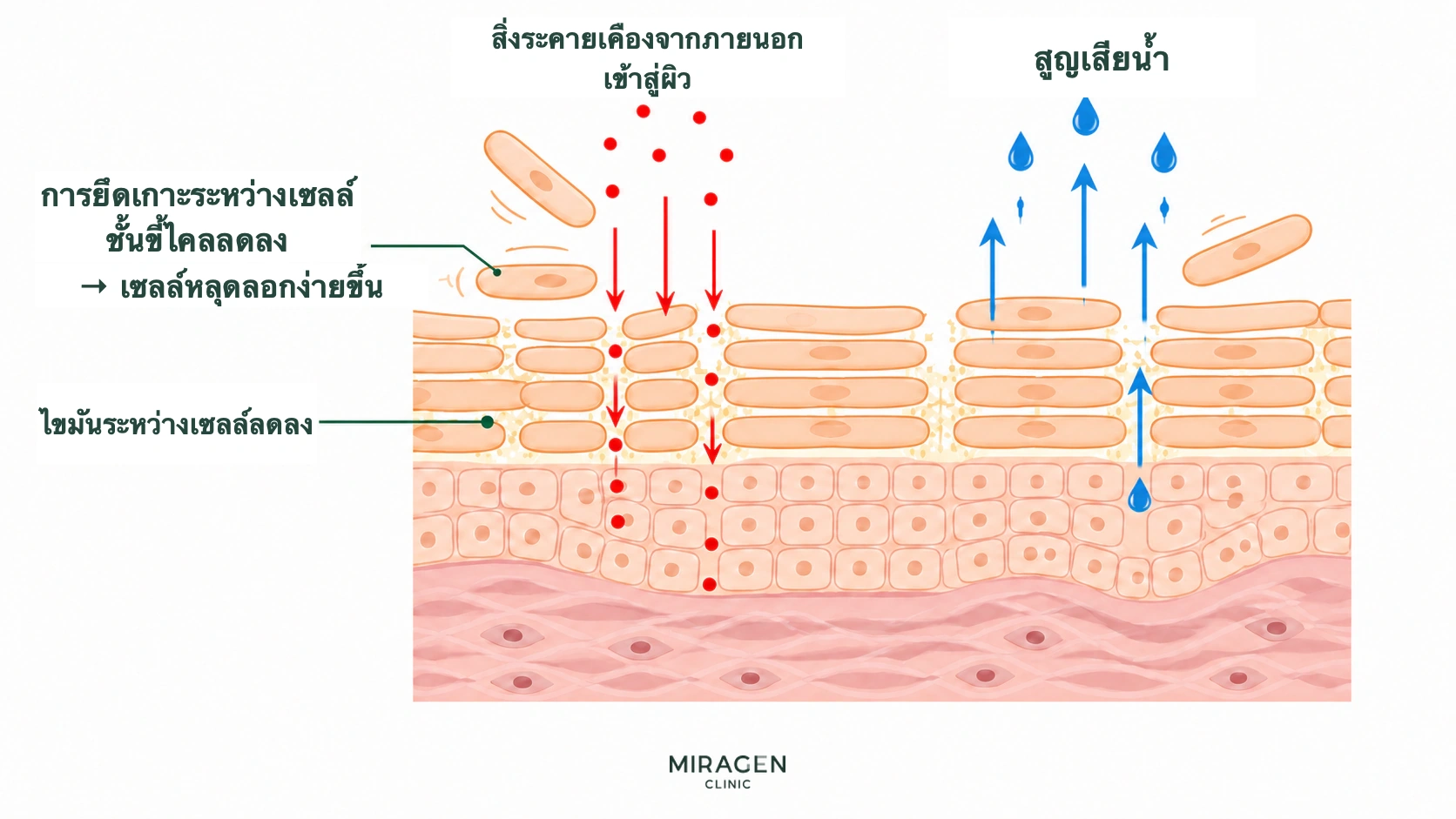 ภาพแสดงการเปลี่ยนแปลงเกราะผิวระหว่างกินไอโซตินอน เมื่อการยึดติดของเซลล์ผิวและไขมันระหว่างเซลล์ลดลง สิ่งระคายเคืองผ่านง่ายขึ้นและน้ำสูญเสียจากผิวมากขึ้น