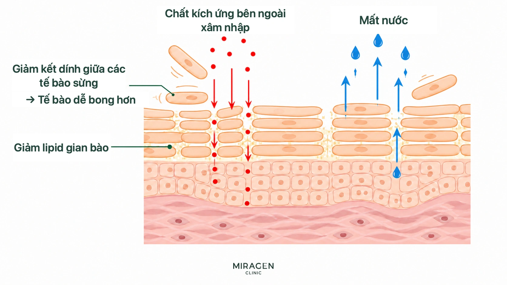 Hình hàng rào da khi dùng Isotinon: liên kết và lipid giữa tế bào sừng giảm, chất kích ứng dễ đi vào và nước dễ thoát