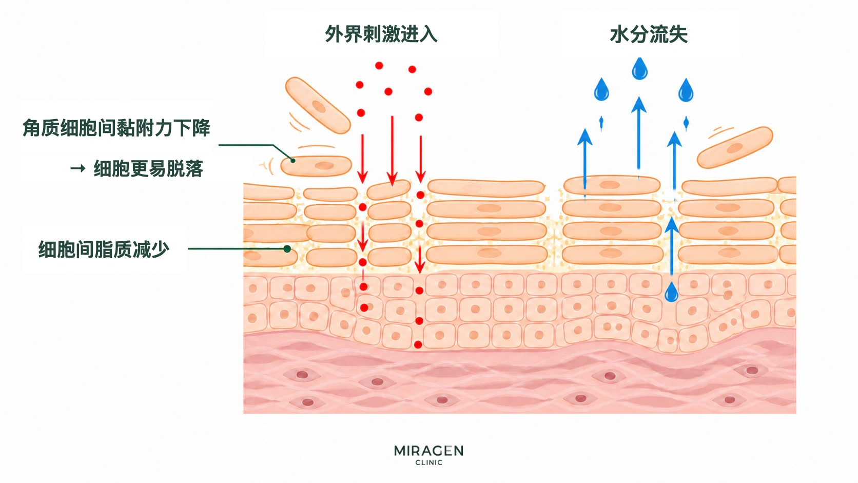 示意图显示服用异维A酸后，角质细胞之间的黏附力和细胞间脂质减少，皮肤屏障因而更容易让外界刺激进入，并加速水分流失