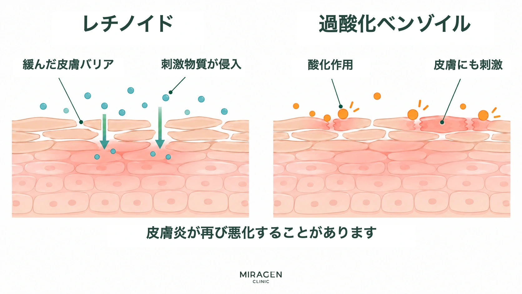 レチノイドによって皮膚バリアが緩み刺激物質が侵入する過程と、過酸化ベンゾイルの酸化作用が皮膚にも刺激を与える過程を並べて示す皮膚断面図