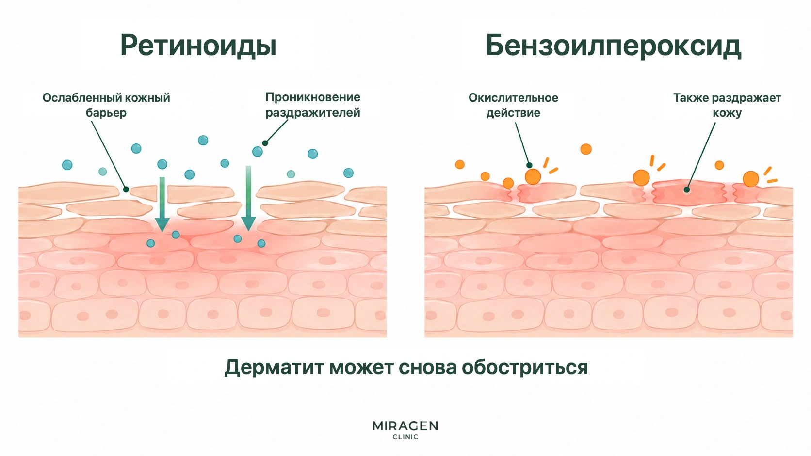 На двух разрезах кожи показано, как ретиноиды ослабляют кожный барьер и пропускают раздражители, а окислительное действие бензоилпероксида раздражает и саму кожу