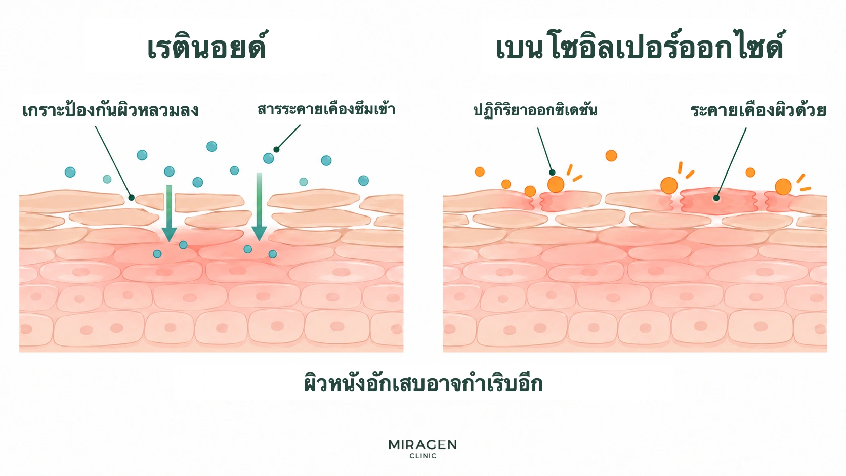 ภาพตัดขวางเปรียบเทียบเกราะป้องกันผิวที่คลายตัวจากเรตินอยด์จนสารระคายเคืองเข้าได้ กับปฏิกิริยาออกซิเดชันของเบนโซอิลเปอร์ออกไซด์ที่ระคายเคืองผิวด้วย