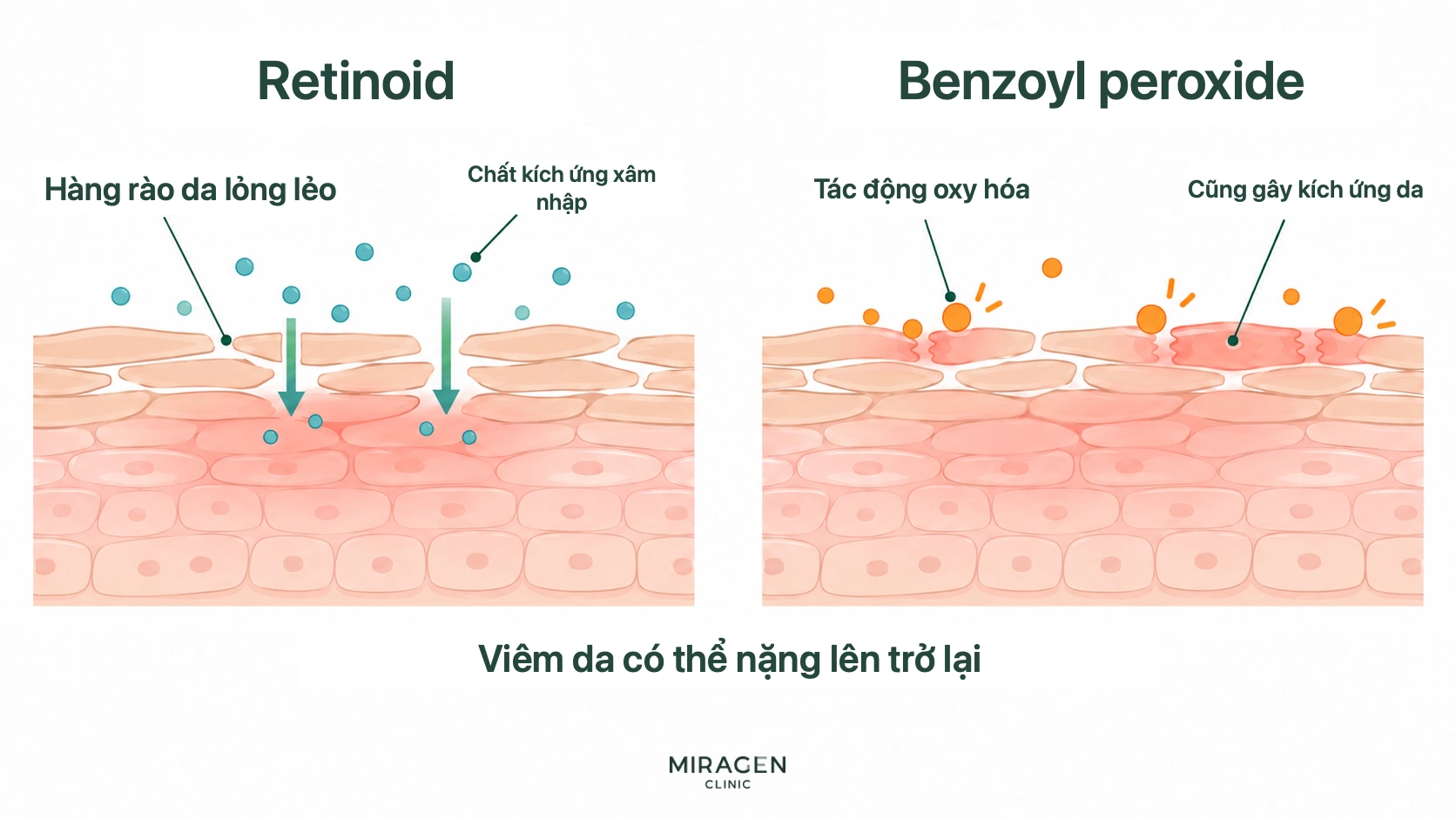 Hình cắt lớp da so sánh retinoid làm hàng rào da lỏng lẻo để chất kích thích đi vào và tác động oxy hóa của benzoyl peroxide gây kích ứng da