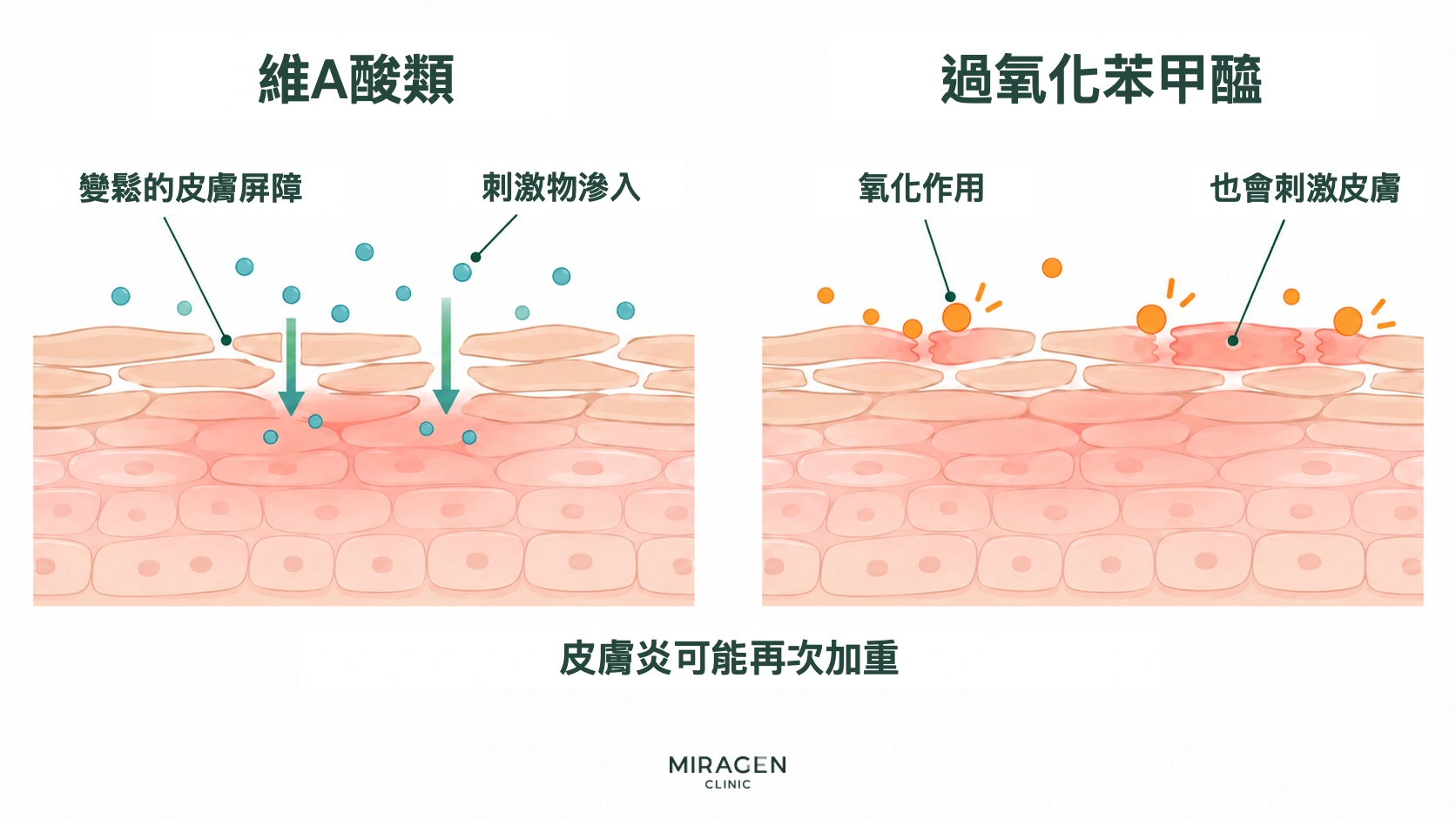 並列的皮膚剖面圖,一側展示維A酸類藥物使皮膚屏障鬆動、刺激物進入的過程,另一側展示過氧化苯甲醯的氧化作用也會刺激皮膚
