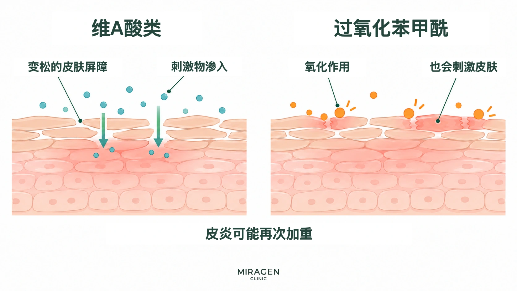 并列的皮肤剖面图,一侧展示维A酸类药物使皮肤屏障松动、刺激物进入的过程,另一侧展示过氧化苯甲酰的氧化作用也会刺激皮肤