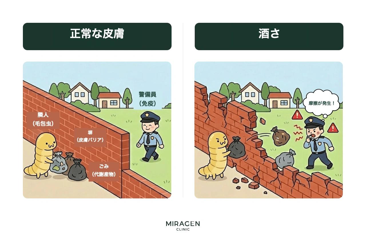 デモデックス毛包虫と皮膚バリアの関係を塀の比喩で説明し、塀が丈夫であれば毛包虫の代謝産物は浸透しませんが、バリアが崩れると免疫との摩擦が生じるという酒さの発生原理を示しています。