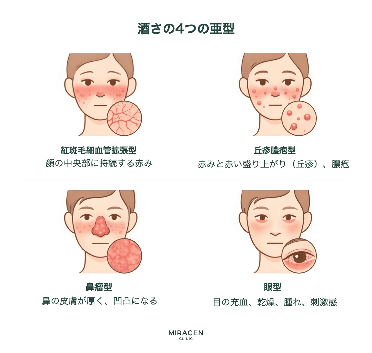 酒さの4つのタイプ分類：紅斑毛細血管拡張型は顔の赤み、丘疹膿疱型はニキビに似た丘疹、鼻瘤型は鼻の皮膚の肥大、眼型は目の充血と乾燥が特徴である分類体系を視覚的に比較します。