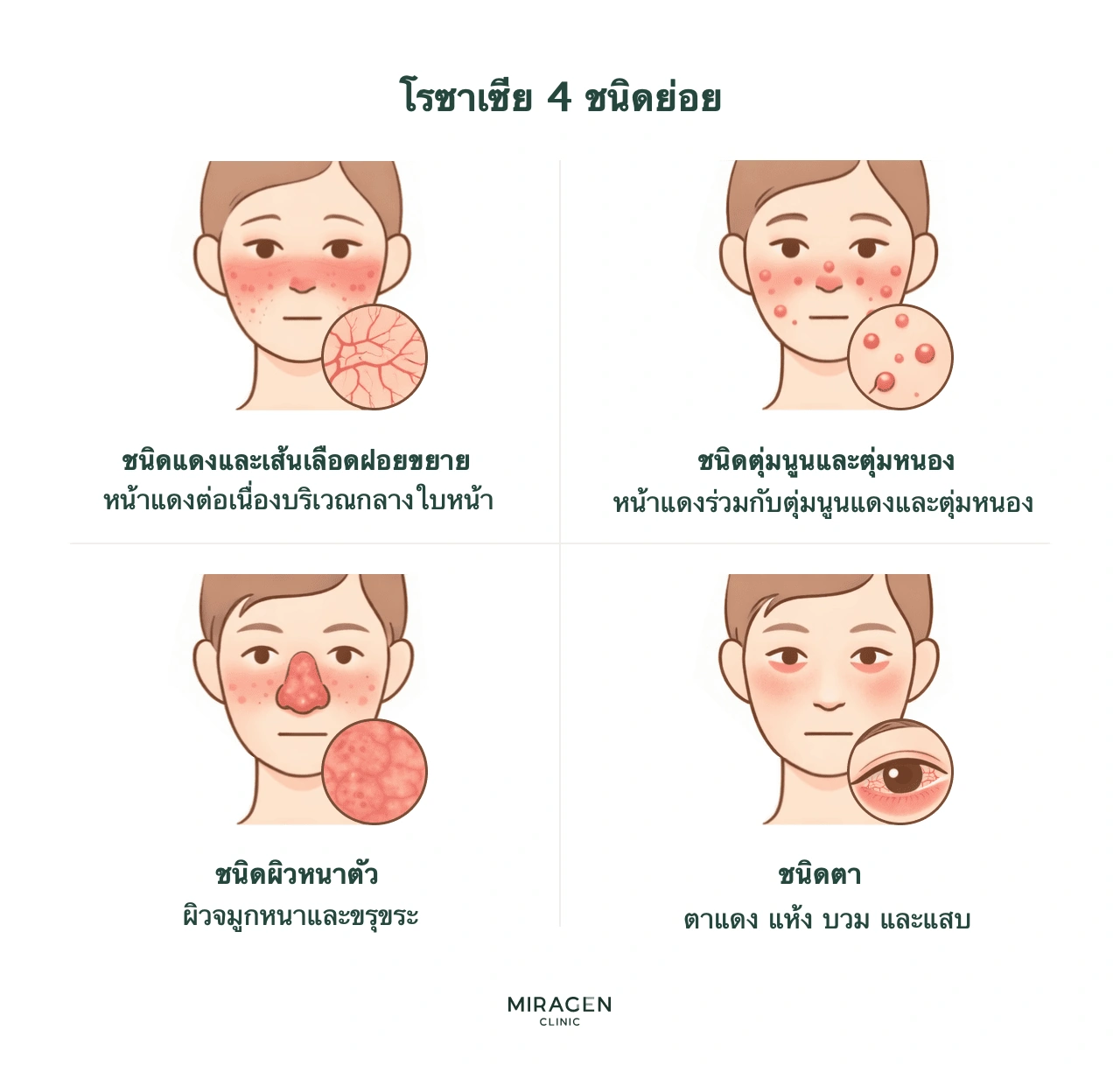 ภาพเปรียบเทียบโรซาเซียสี่ชนิด ได้แก่ หน้าแดงและหลอดเลือดขยาย ตุ่มนูนตุ่มหนอง ผิวจมูกหนา และชนิดที่ตาซึ่งตาแดงและแห้ง