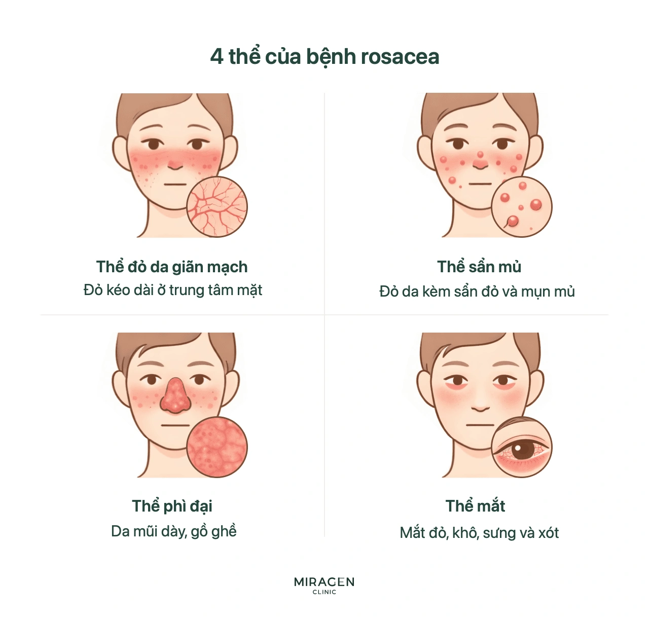 So sánh bốn thể rosacea: đỏ da và giãn mạch, sẩn mụn mủ, da mũi phì đại, cùng mắt đỏ và khô