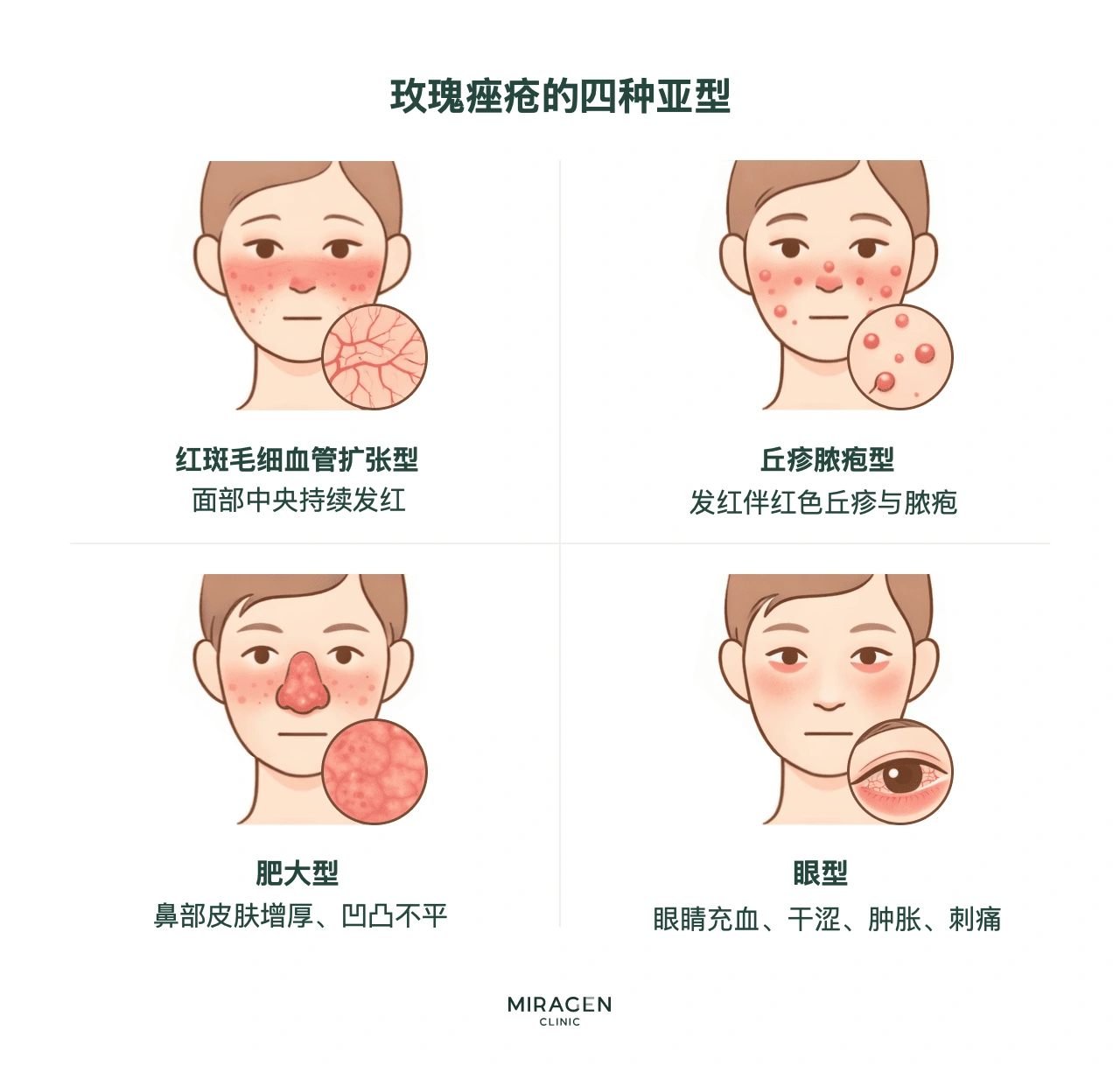 分类信息图：对比玫瑰痤疮四种类型——红斑毛细血管扩张型的面部泛红、丘疹脓疱型的痤疮样丘疹、鼻赘型的鼻部皮肤增厚，以及眼型的充血和干燥