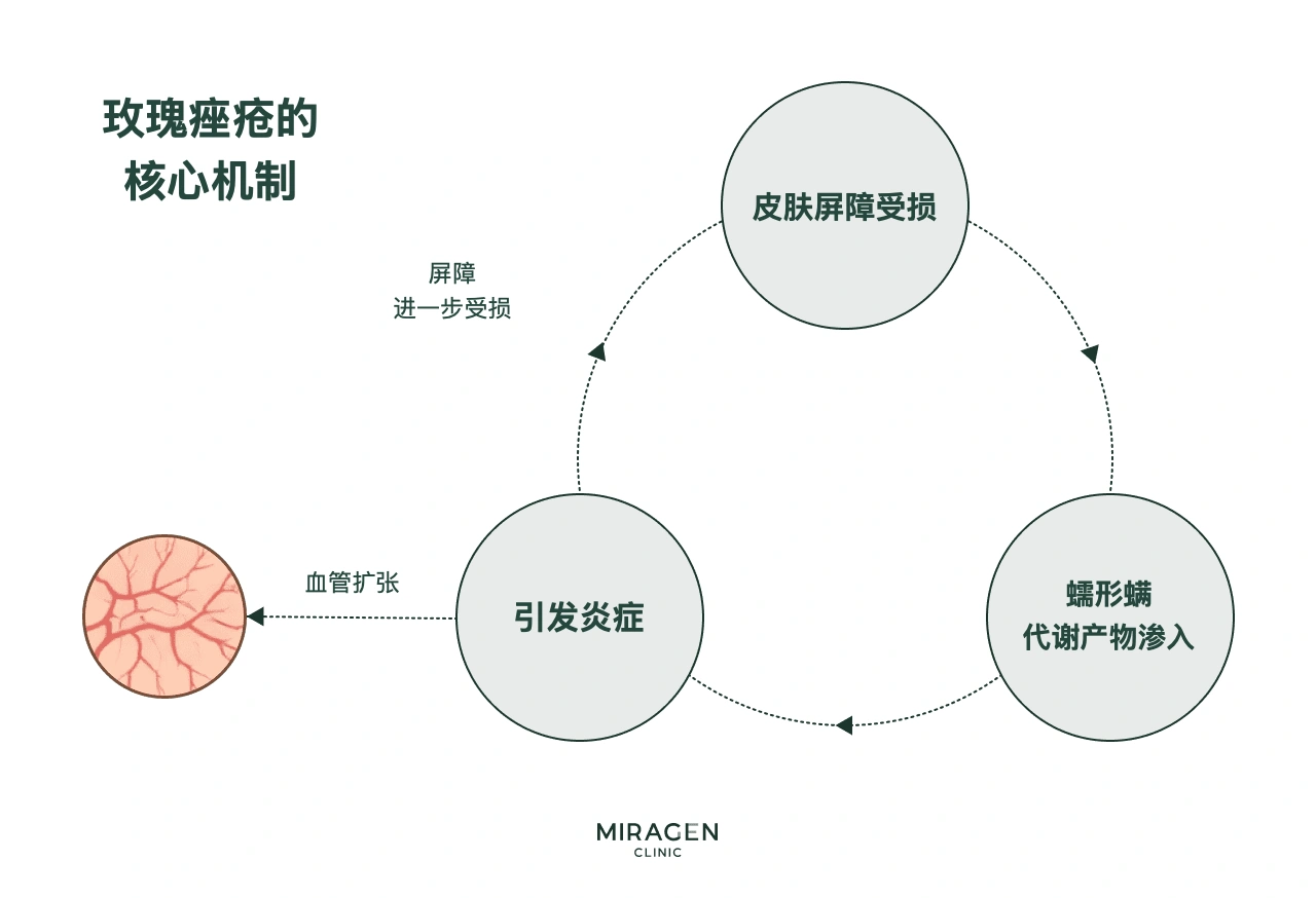 循环图：皮肤屏障受损后，血管扩张，毛囊蠕形螨残留物进入皮肤并引起炎症；炎症又继续损伤屏障，形成恶性循环
