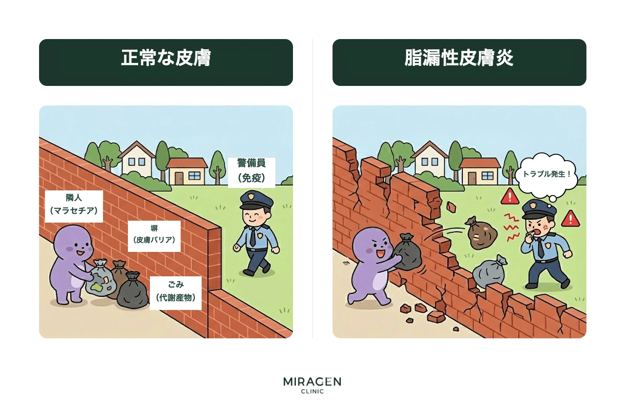 丈夫な塀が隣人のゴミを防ぐ正常な皮膚と、塀が崩れて警備員との摩擦が生じる脂漏性皮膚炎を、皮膚バリア・マラセチア・免疫反応に例えて説明したインフォグラフィック