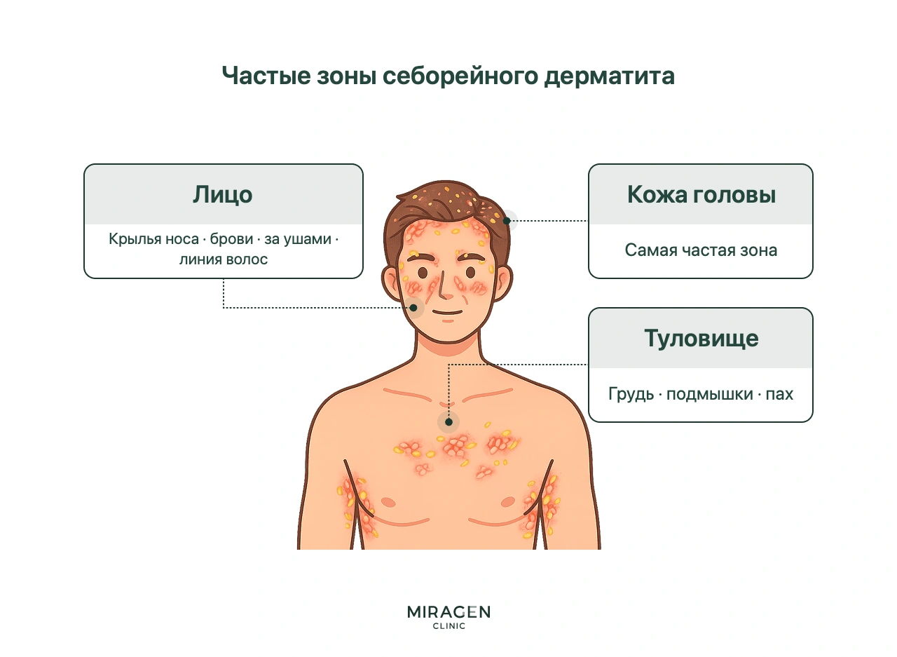 На рисунке верхней части тела мужчины показаны типичные участки себорейного дерматита: волосистая часть головы, лицо — стороны носа, брови, область за ушами и линия роста волос, — верхняя часть груди и подмышки