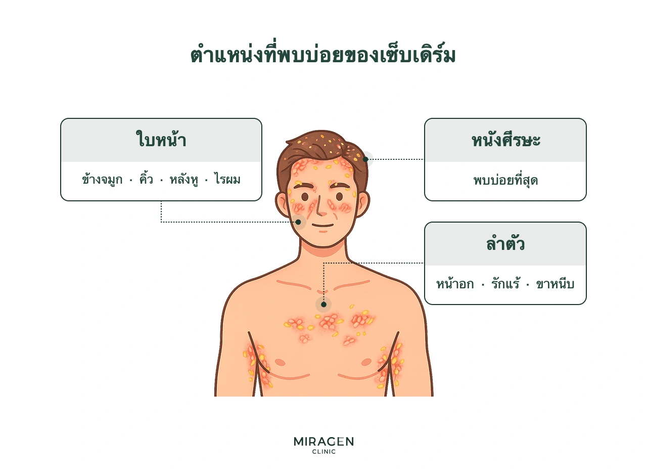 อินโฟกราฟิกแสดงบริเวณที่พบบ่อยของผิวหนังอักเสบเซ็บเดิร์มบนร่างกายผู้ชาย ได้แก่ หนังศีรษะ ใบหน้ารอบจมูก คิ้ว หลังหู ไรผม และลำตัวส่วนหน้าอกหรือรักแร้