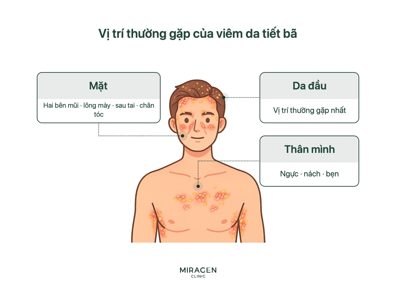 Sơ đồ vùng thường gặp viêm da tiết bã trên nửa thân trên nam giới: da đầu, mặt và thân mình