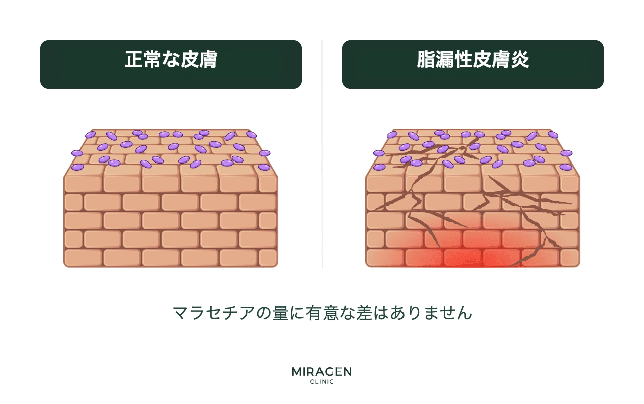 脂漏性皮膚炎患者と正常人の皮膚でマラセチア菌数に差がないことを示し、菌自体ではなくバリアの問題が原因であることを説明するイラスト