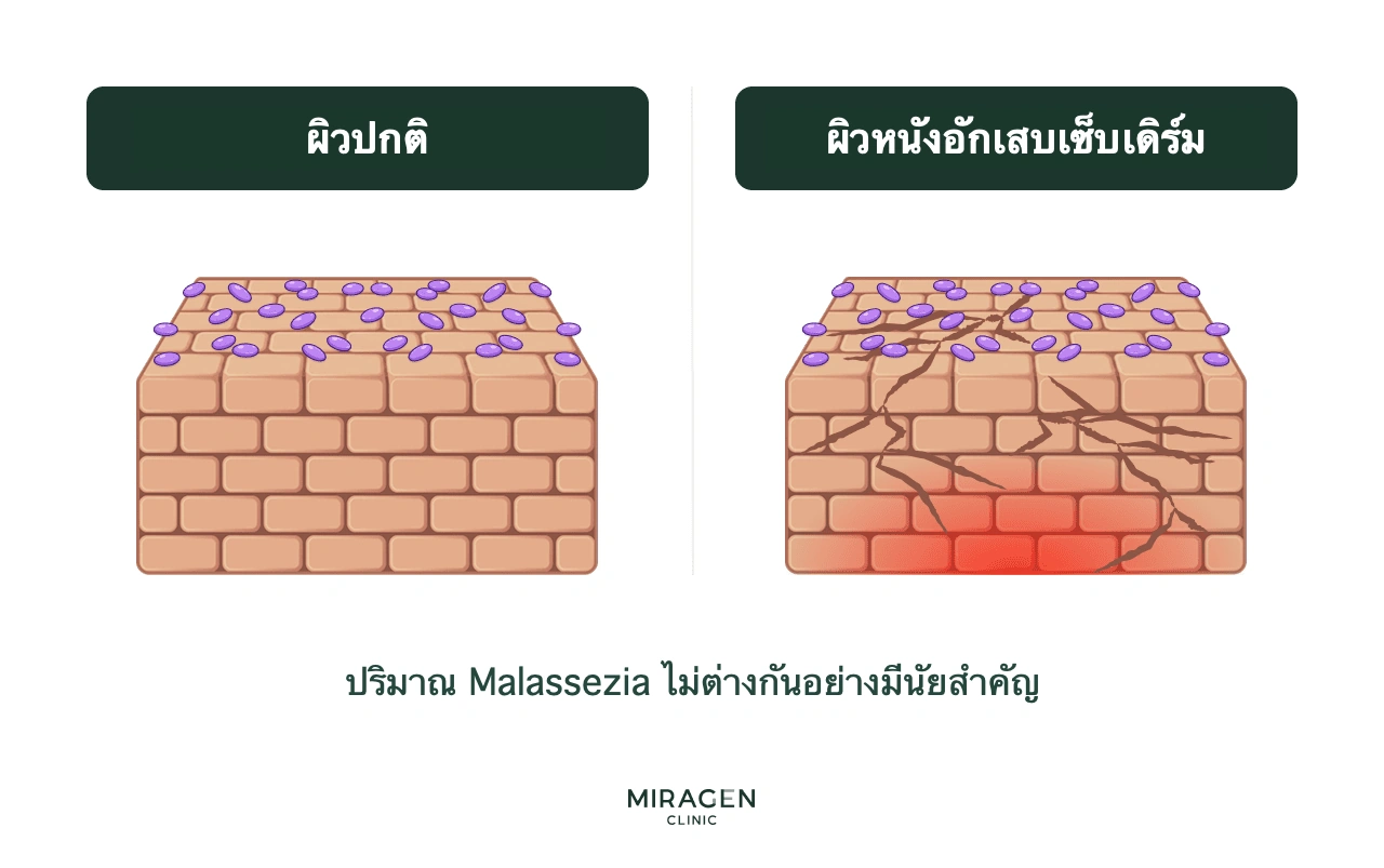 ภาพเปรียบเทียบผิวผู้ป่วยผิวหนังอักเสบเซ็บเดิร์มกับผิวปกติ แสดงจำนวนมาลาสซีเซียไม่ต่างกัน เพื่ออธิบายว่าเกราะป้องกันผิวมีบทบาทสำคัญกว่าจำนวนเชื้อ