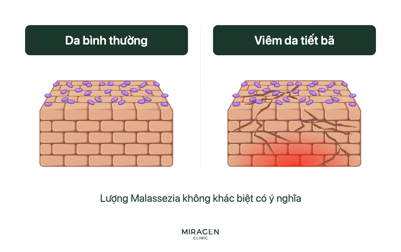 Hình minh họa lượng Malassezia không khác biệt giữa da người viêm da tiết bã và da khỏe mạnh, giải thích vai trò của hàng rào da