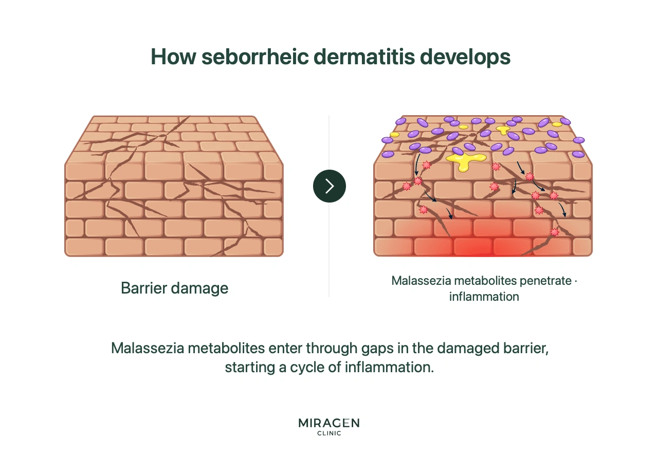 An infographic showing the step-by-step mechanism of seborrheic dermatitis, where Malassezia metabolites penetrate through gaps in a damaged skin barrier to cause inflammation, which then further damages the barrier.
