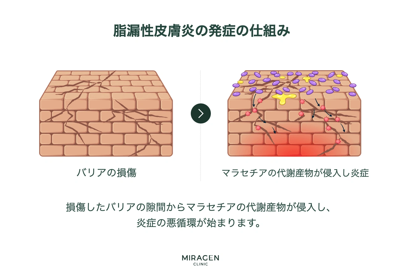 損傷した皮膚バリアの隙間からマラセチアの代謝産物が浸透して炎症を誘発し、炎症がバリアをさらに損傷させる悪循環の機序を段階的に示す脂漏性皮膚炎発症メカニズムのインフォグラフィック
