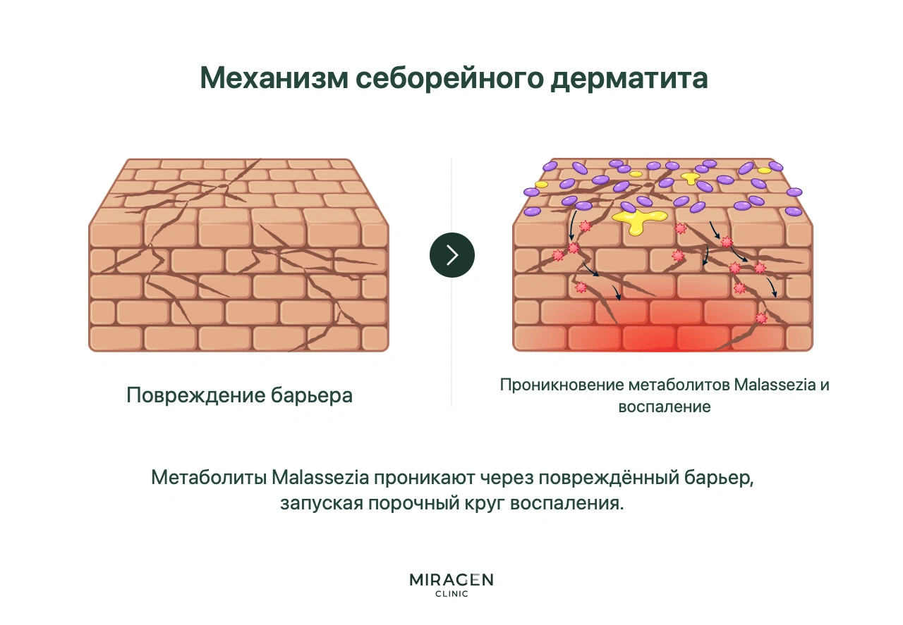 Инфографика поэтапно показывает замкнутый круг: продукты обмена Malassezia проникают через повреждённый кожный барьер, вызывают воспаление, а воспаление дополнительно повреждает барьер