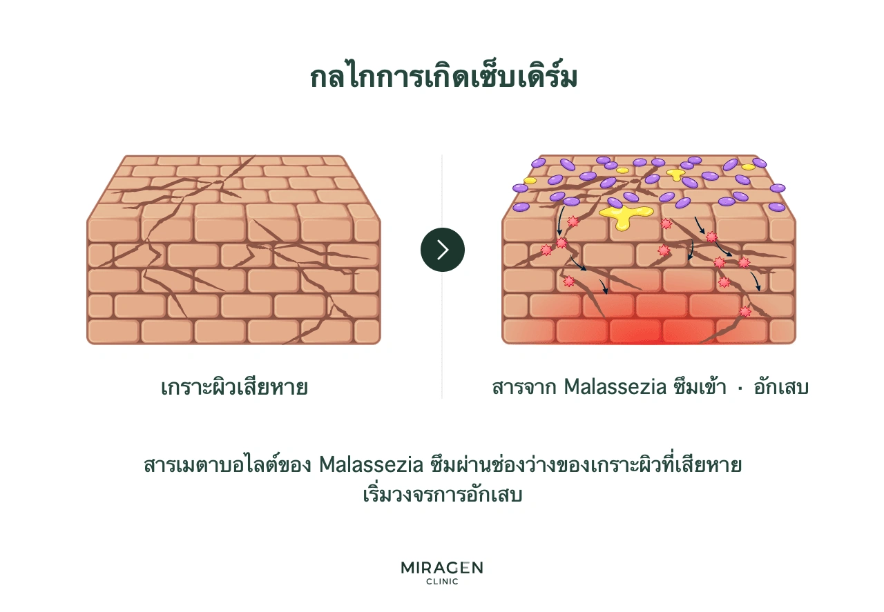 อินโฟกราฟิกแสดงผลผลิตจากมาลาสซีเซียผ่านช่องว่างของเกราะป้องกันผิวที่เสียหาย กระตุ้นการอักเสบ และการอักเสบทำให้เกราะเสียหายเพิ่มเป็นวงจร