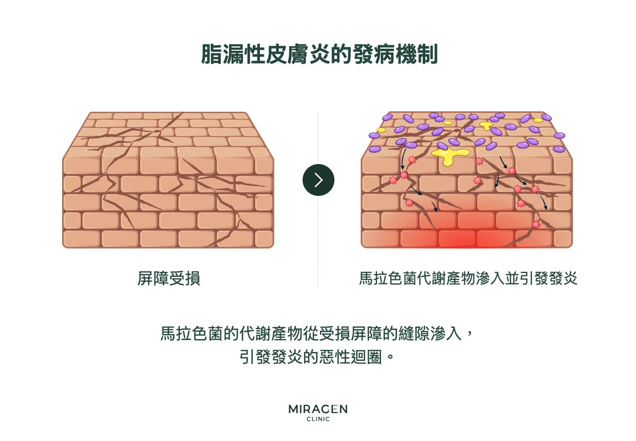 資訊圖:馬拉色菌代謝產物穿過受損皮膚屏障的間隙,引發發炎;發炎進一步損傷屏障,形成脂漏性皮膚炎的惡性迴圈