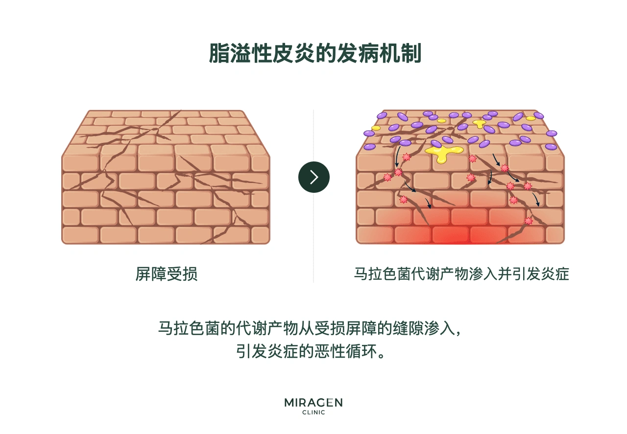 信息图：马拉色菌代谢产物穿过受损皮肤屏障的间隙，引发炎症；炎症进一步损伤屏障，形成脂溢性皮炎的恶性循环